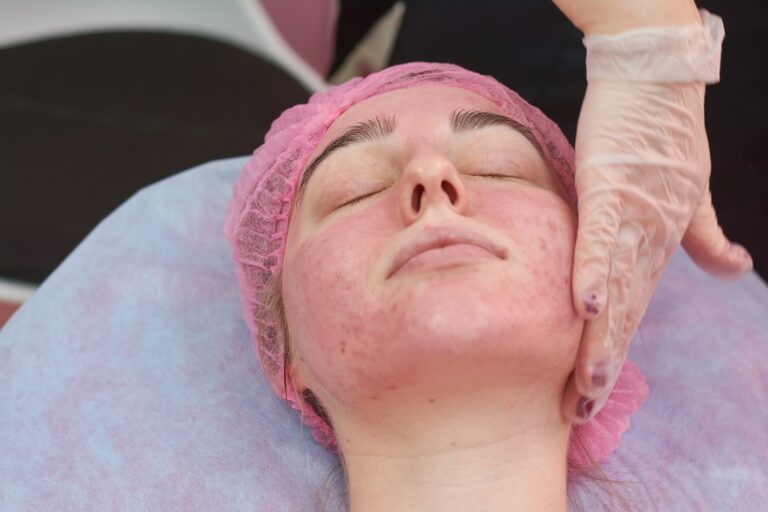 Is Rosacea Treatment Covered by Medicare in NSW?