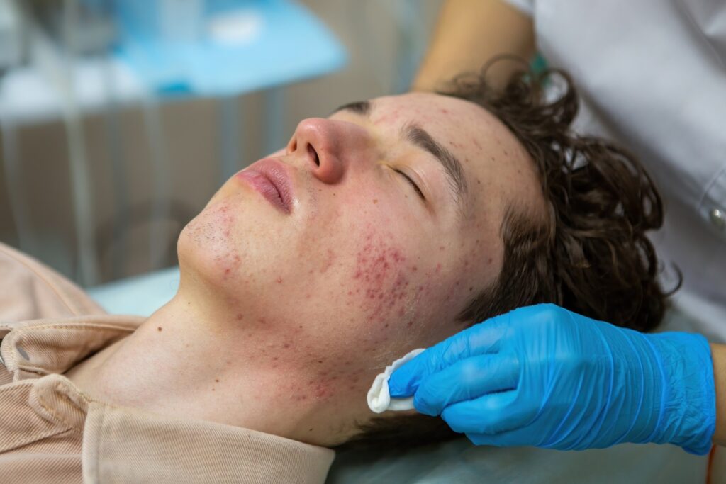 Understanding Rosacea and Its Impact