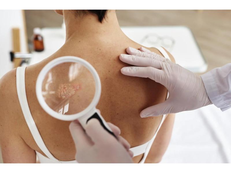 ABC Radio Sydney Interviews Dr Ritu on Skin Cancer for Melanoma March