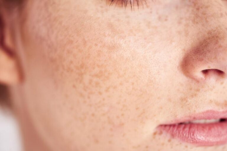 The "Sydney Sun" Damage: Post-Summer Face Pigmentation Fixes