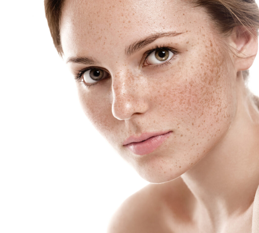 Hyperpigmentation: A Specialist Dermatologist's Guide to Fading Dark Spots