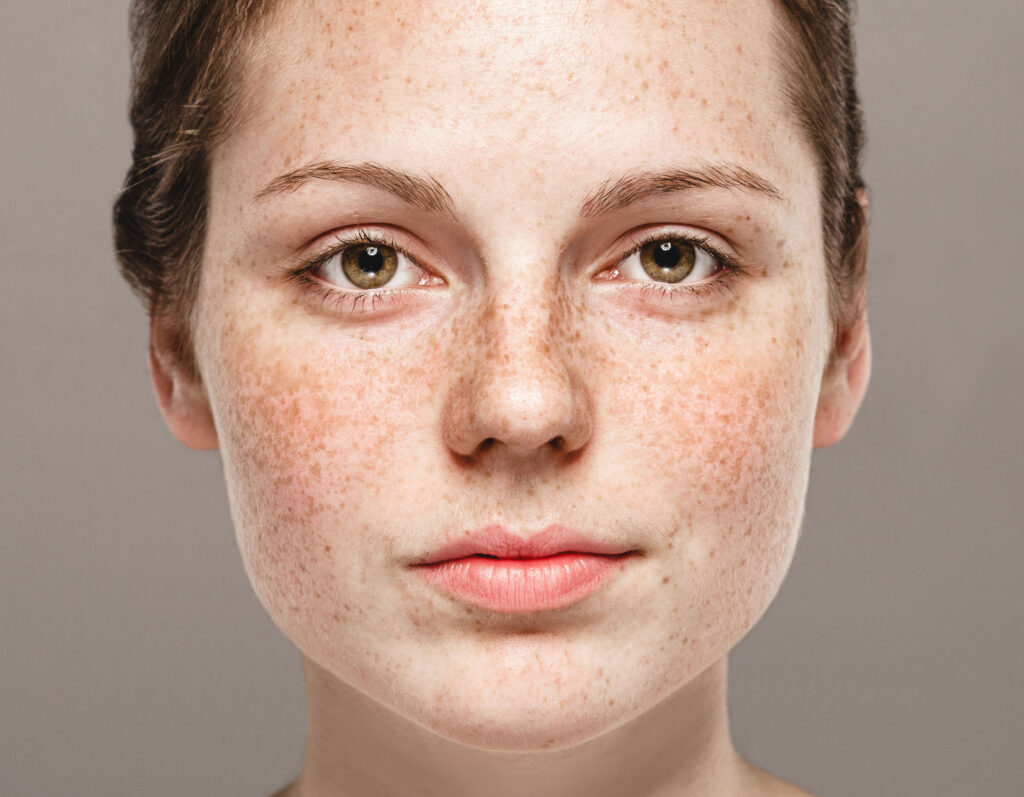 Melasma vs Sun Spots: Pigmentation on face