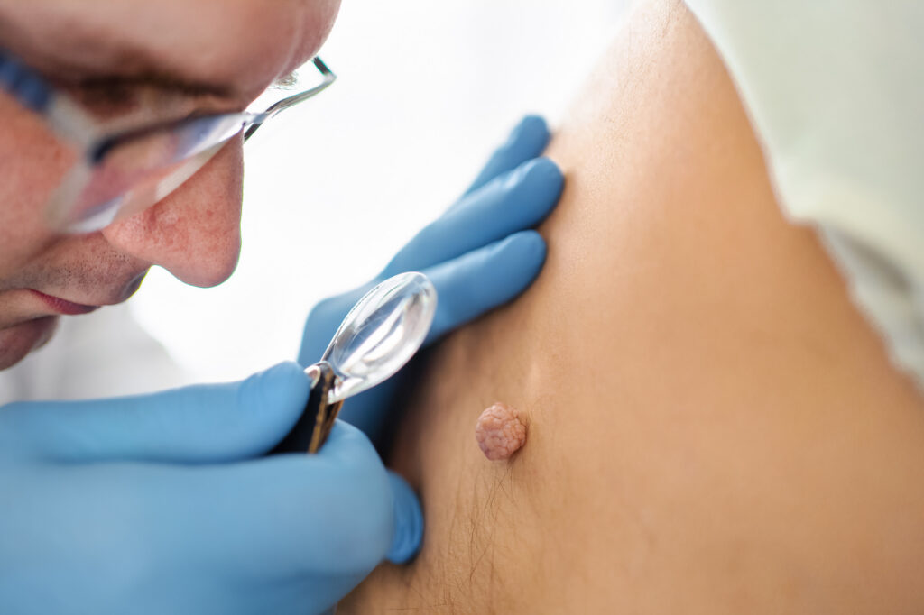 When is a skin mole cancerous?